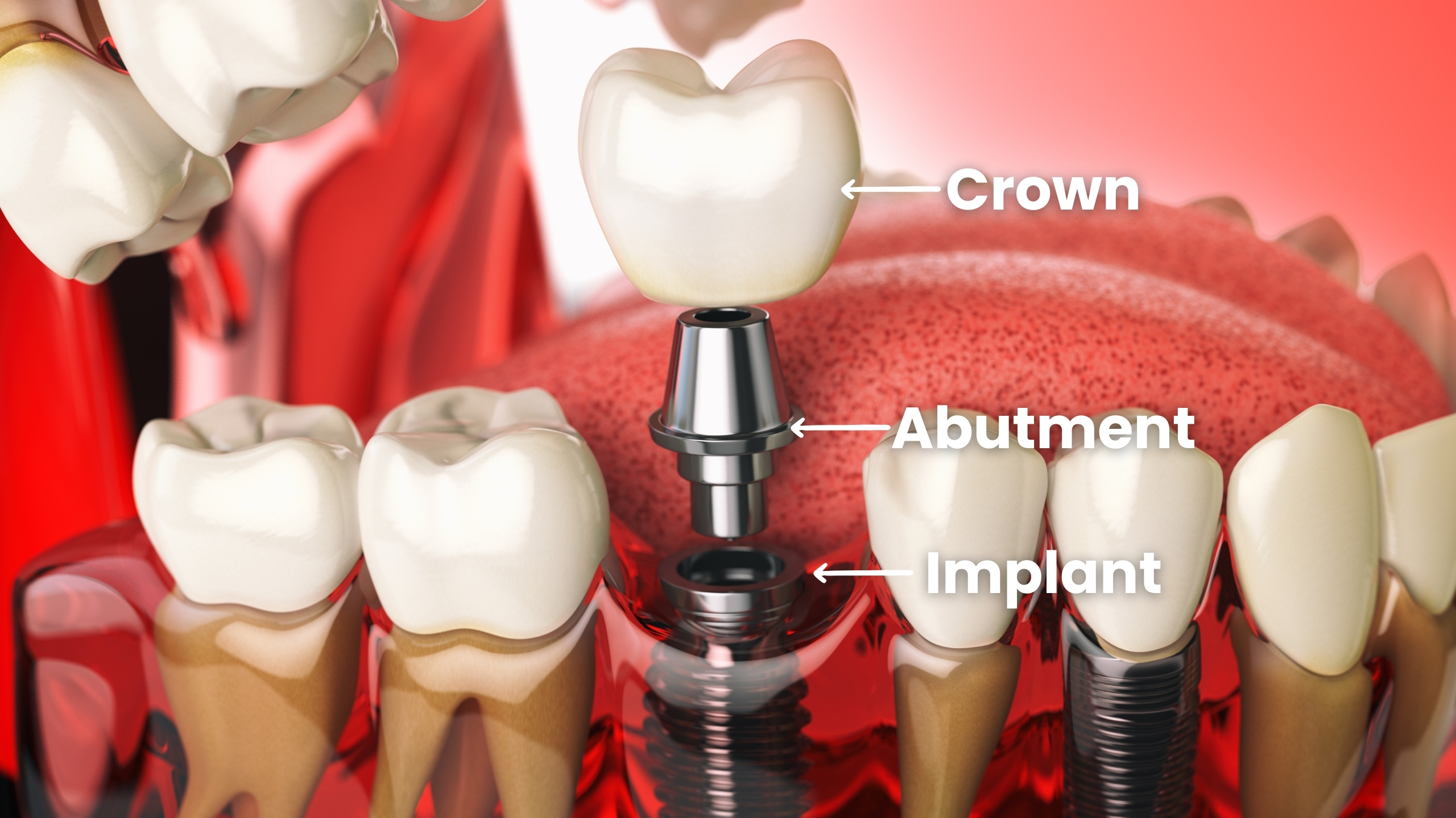 3-part dental implant diagram showing Crown, Abutment, and Implant post