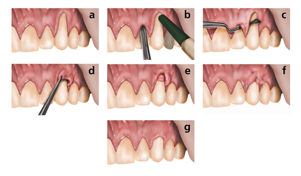 Connective tissue graft procedure for gum recession
