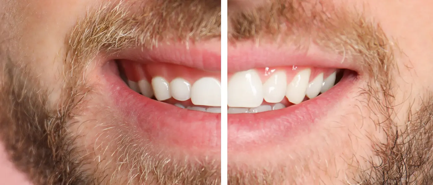 Gummy smile before aesthetic crown lengthening
