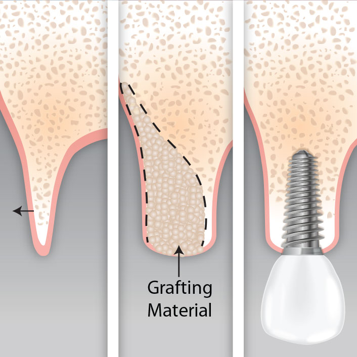 Guided bone regeneration with grafting material for implant placement