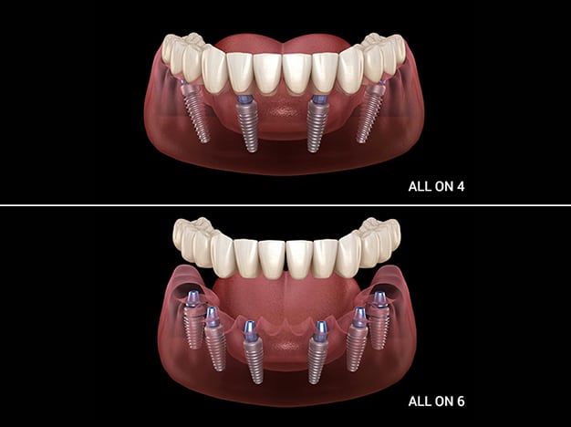 All-On-X full arch implant configuration