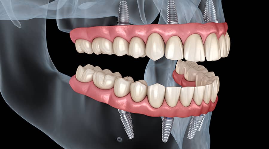 All-On-X implant procedure