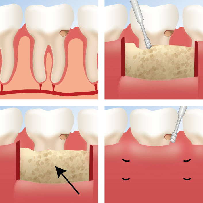 Functional crown lengthening procedure steps