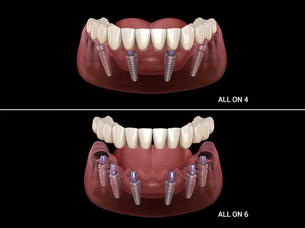 All-On-X full arch implant configuration