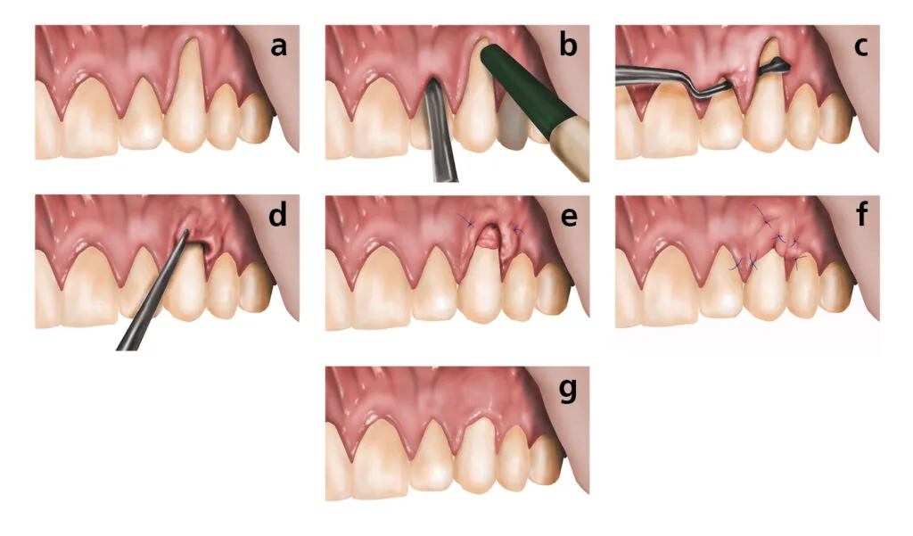 Connective tissue graft procedure for gum recession