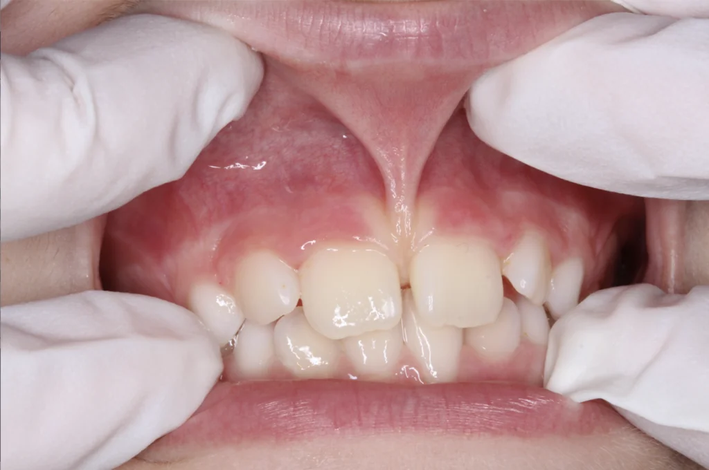 Prominent labial frenum causing gap between upper front teeth