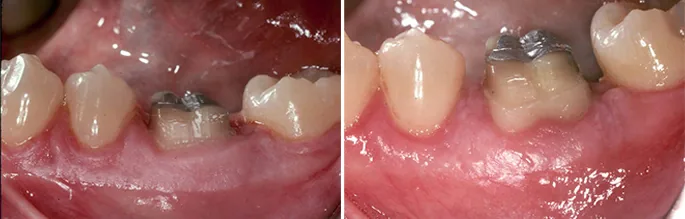 Functional crown lengthening before and after