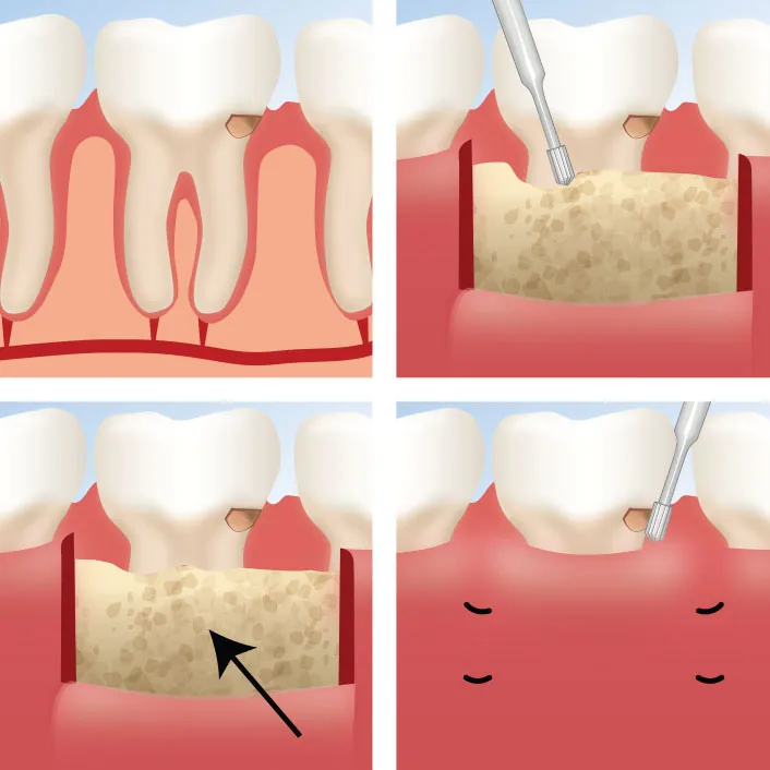 Functional crown lengthening procedure steps