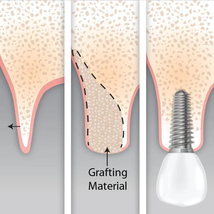 Guided bone regeneration with grafting material for implant placement