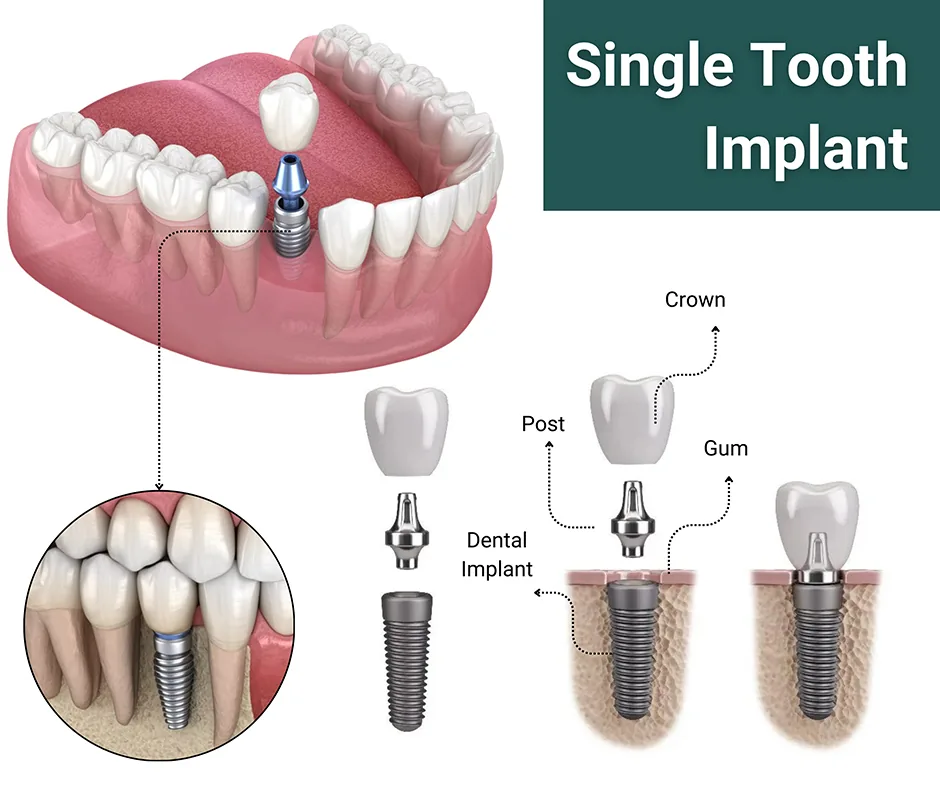 Implant anatomy diagram