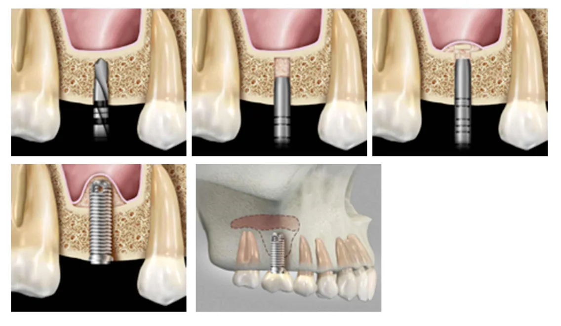 Internal sinus lift procedure