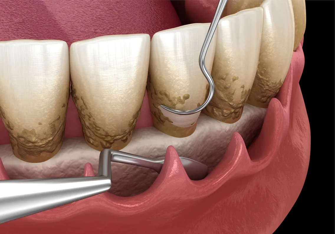 Osseous surgery bone recontouring procedure