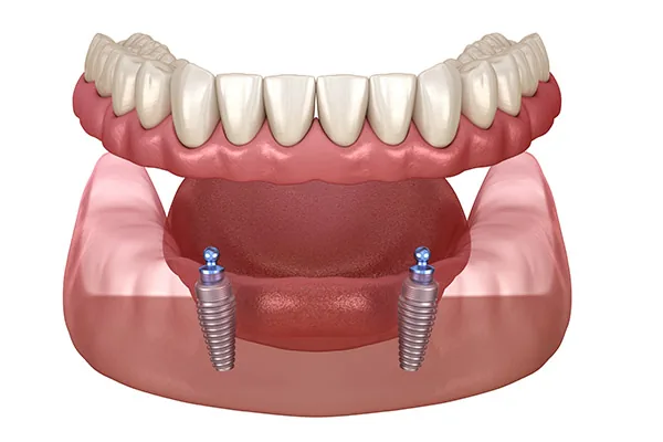 Implant-supported overdenture procedure