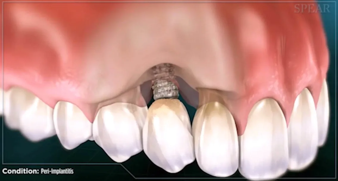 Peri-implantitis condition around dental implant