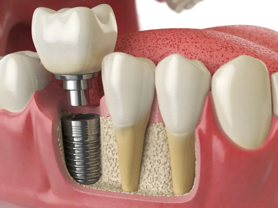 Dental implant cross-section showing crown, abutment, titanium post and jawbone