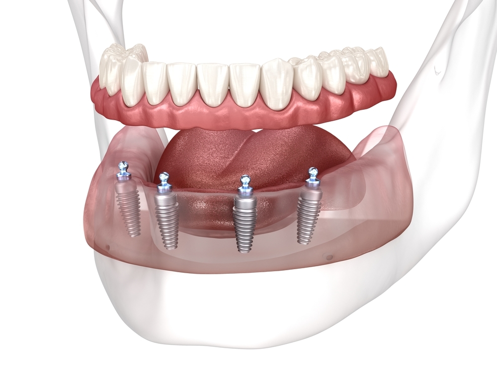 Implant-supported overdenture snap-in attachment