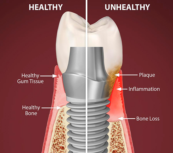 Peri-implantitis treatment