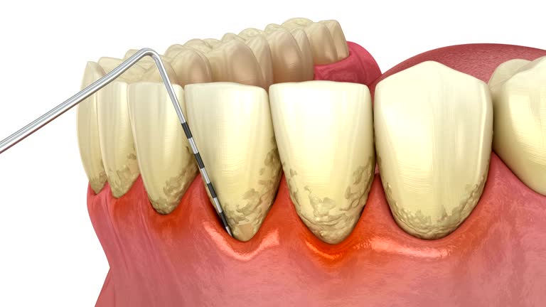 Periodontal disease with deep pockets and bone loss
