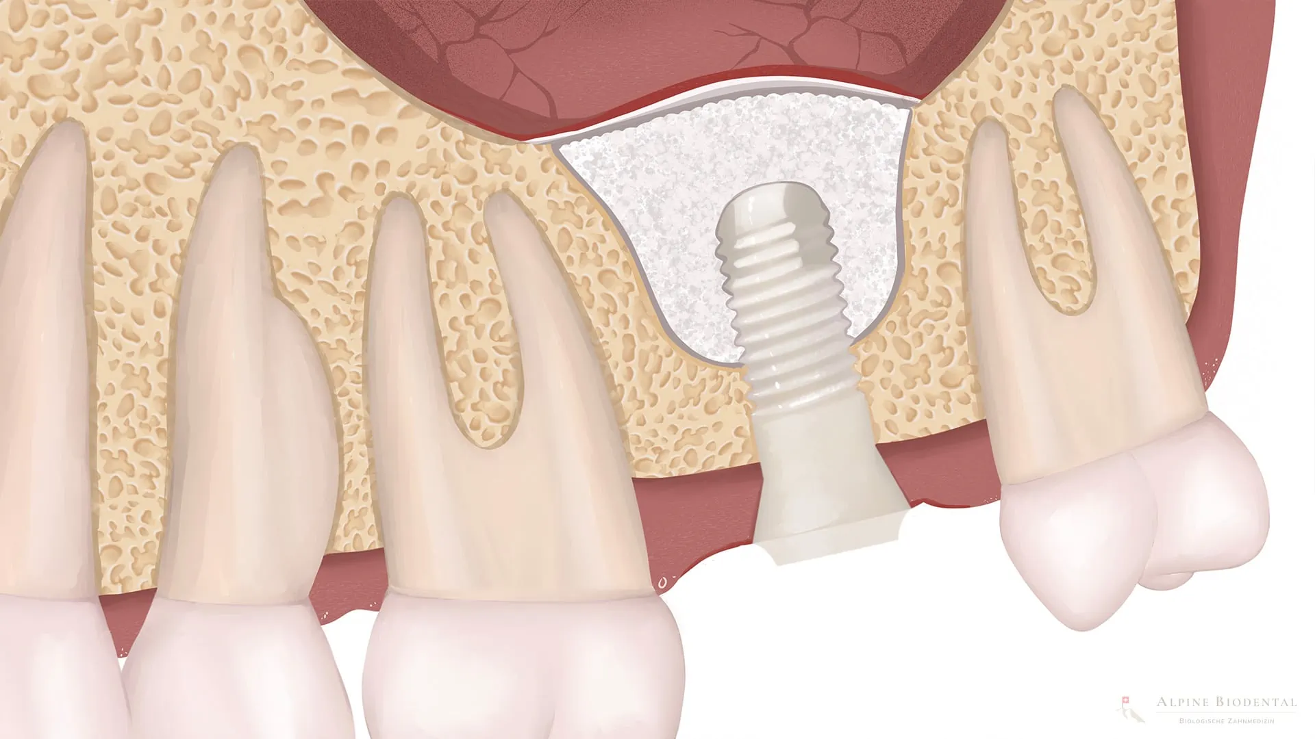 Internal sinus lift with simultaneous implant placement