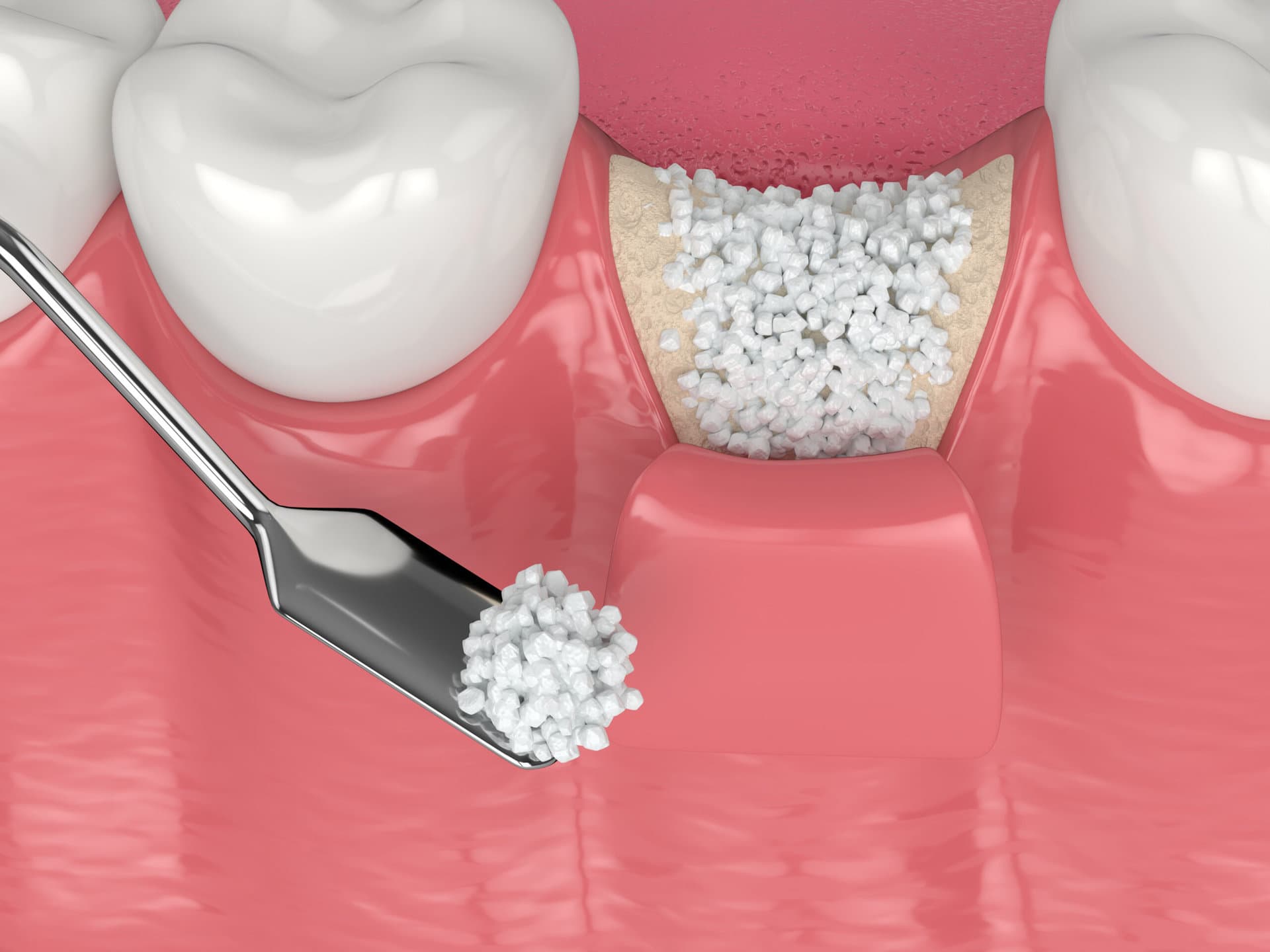 Socket preservation bone grafting