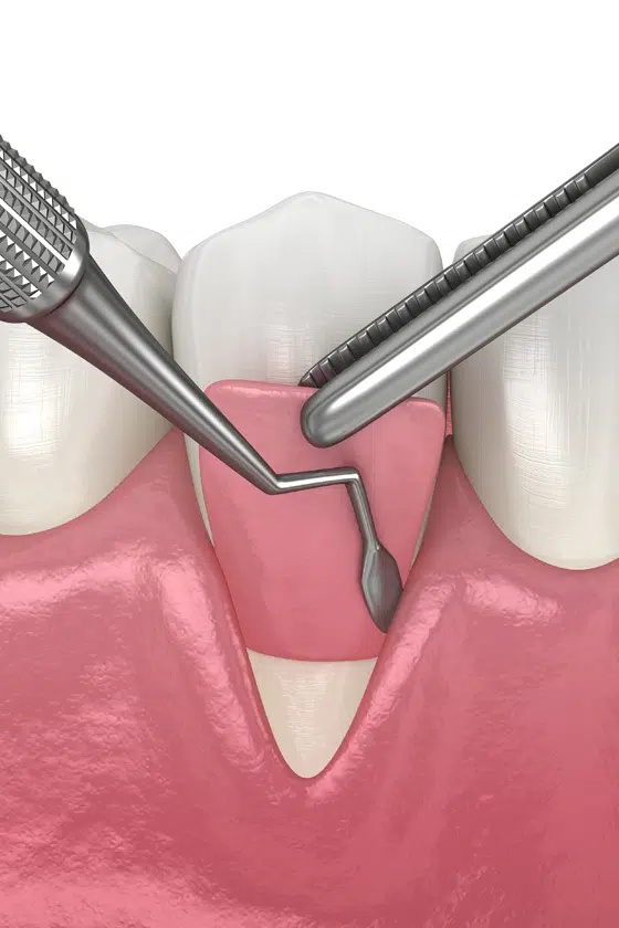 Tissue grafting procedure for gum recession treatment